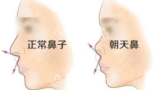 正常鼻子和朝天鼻的区别图片