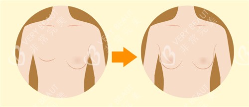 乳房重建手术