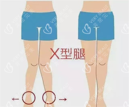 X型腿示意图