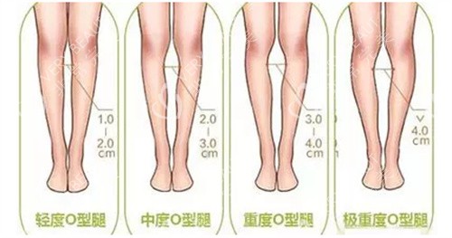 腿型歪斜程度