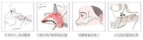 颧骨颧弓磨骨手术过程示意图