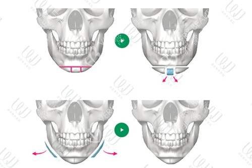 下巴手术下颌角