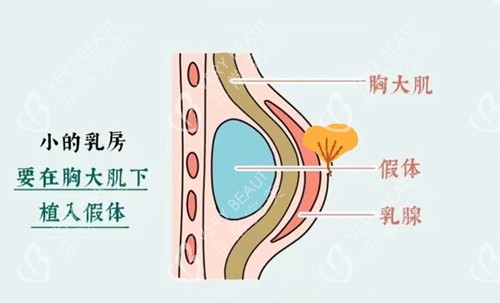 假体隆胸放置位置示意图