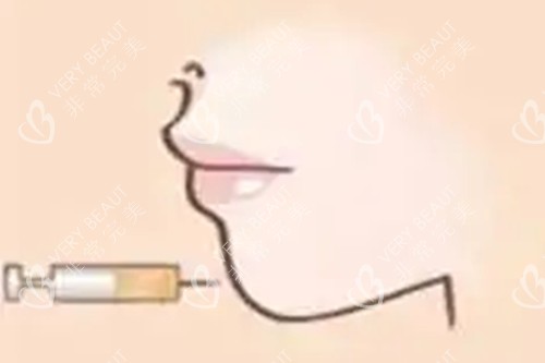 玻尿酸注射卡通图