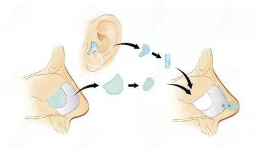 隆鼻耳软骨示意图