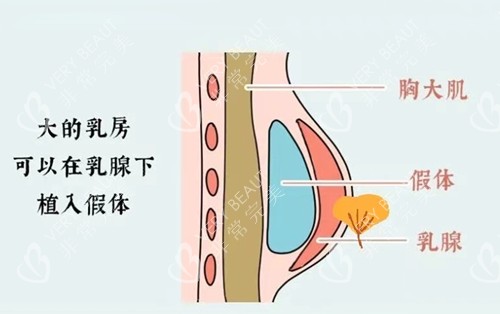 假体隆胸放置位置示意图
