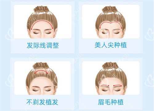 女性发际线植发图