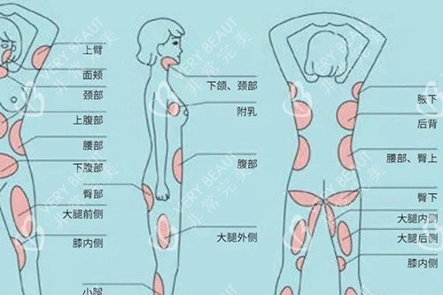全身吸脂部位图展示