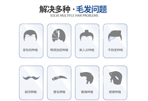 毛发种植类型示意图