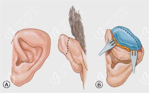 耳整形手术示意图