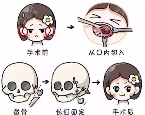 樸鐘哲磨骨示意圖