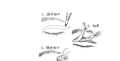 双眼皮手术示意图