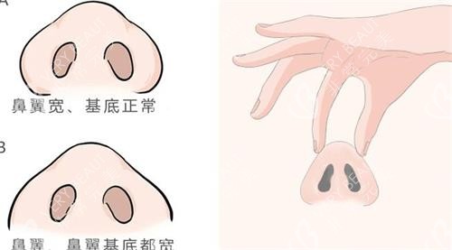 隆鼻整形示意图