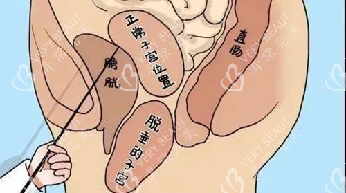 產(chǎn)后脫垂的子宮