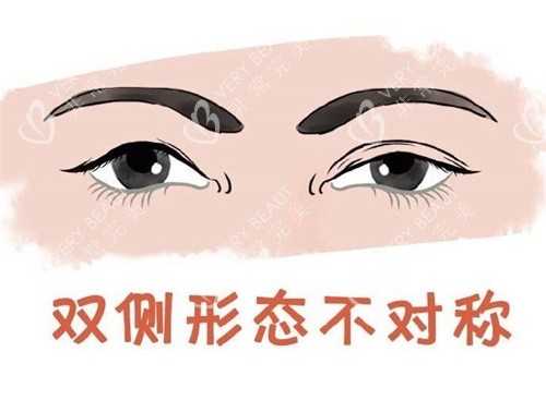双眼皮修复