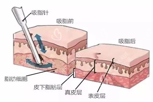 吸脂過程圖