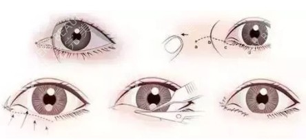 眼部手术过程示意图