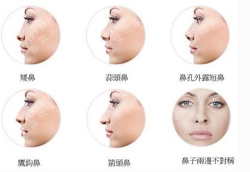 各种鼻部形态示意图