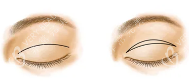 双眼皮手术方式展示图