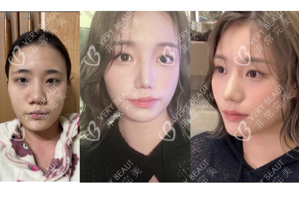 韩国VG百利酷整形外科鼻子对比图