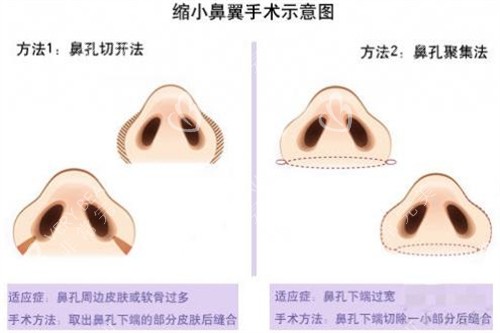 鼻翼縮小術(shù)示意圖
