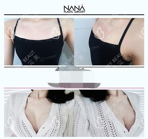 韩国NANA整形外科隆胸示意图 