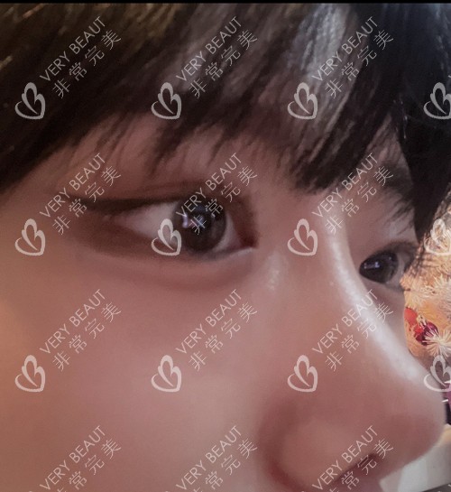 韩国4月31日整形鼻综合术后