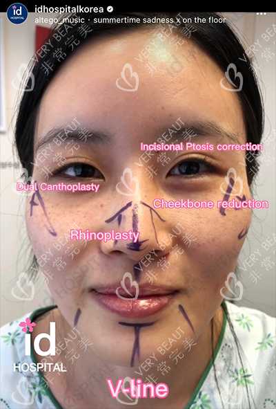 韓國ID整形輪廓手術(shù)改善方案