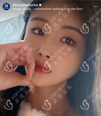 韓國輪廓整形術(shù)后展示