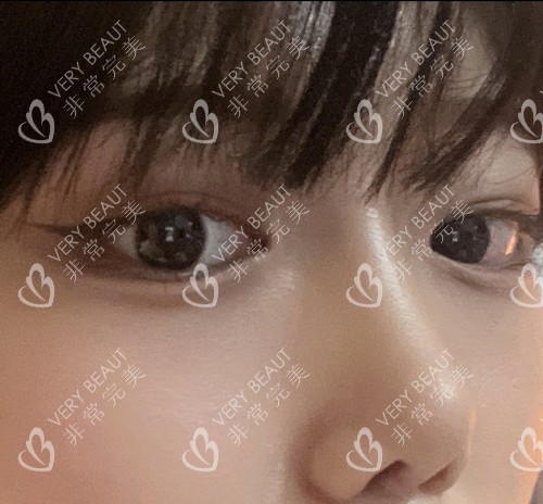 韩国4月31日整形外科眼综合术后