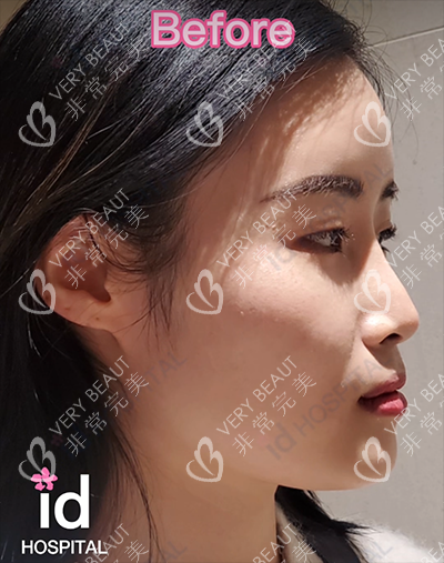 韓國ID整形輪廓手術(shù)術(shù)前側(cè)面