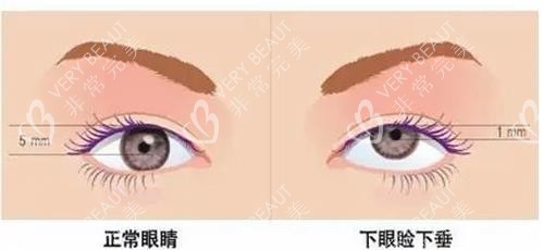 眼部整形示意圖