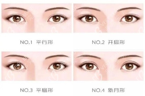 双眼皮类型图