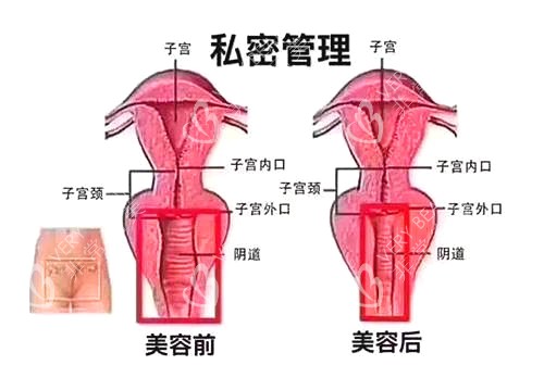 韩国丽姿整形医院外阴整形示意图