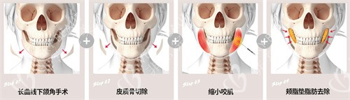 韩国1%整形外科医院all 4 on下颌角手术
