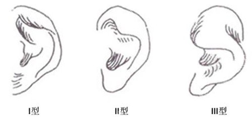 耳朵畸形示意图