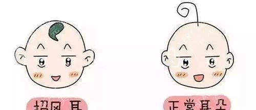 招风耳示意图