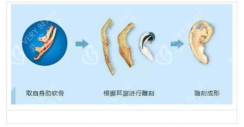 耳朵整形手术示意图