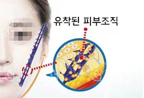 韓國德社羅伊整形外科埋線提升
