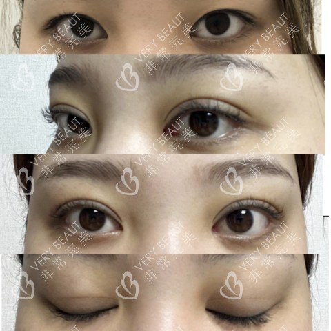 韓國可來熙整形外科雙眼皮修復對比圖
