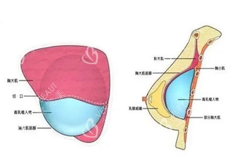 假体隆胸假体植入位置示意图