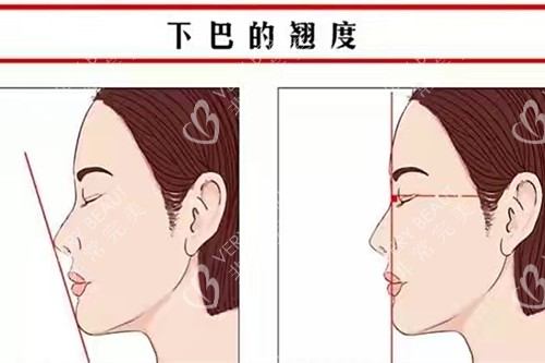 下巴的翹度示意圖