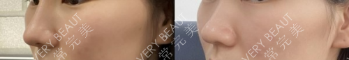 韓國will整形外科醫(yī)院耳軟骨隆鼻對比圖
