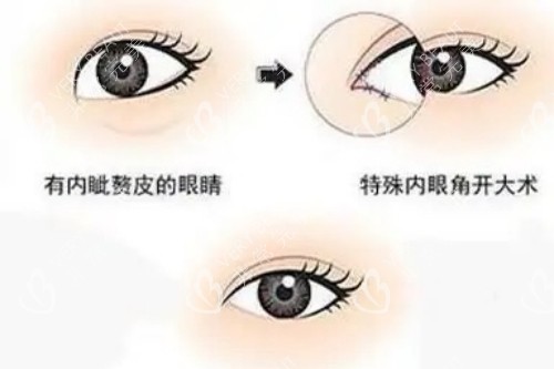 開內(nèi)眼角示意圖