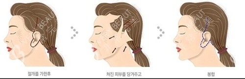 韓國(guó)VG百利酷整形外科拉皮手術(shù)