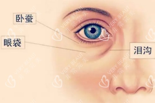 韓國去眼袋填淚溝示意圖