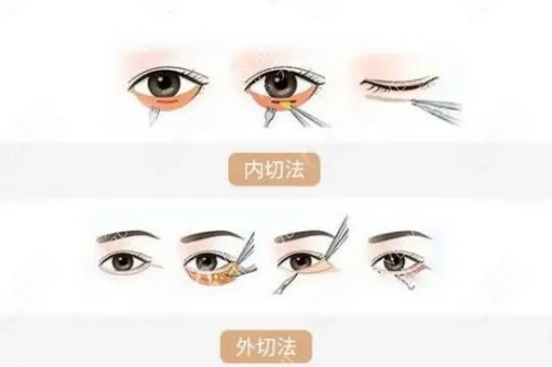 韓國去眼袋手術(shù)方法示意圖