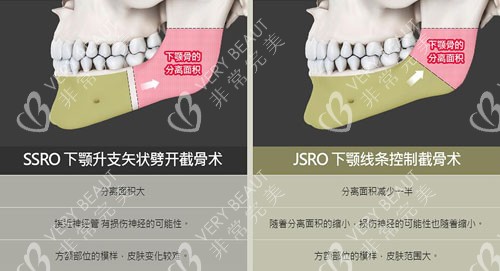 韓國菲斯萊茵雙鄂整形細(xì)節(jié)特點介紹