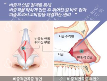 韩国温度整形做鼻子展示