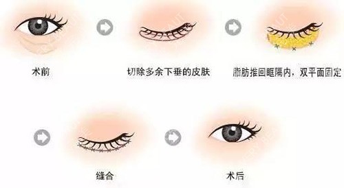 祛眼袋示意图